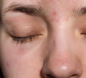 Pimple Between the Eyebrows: Possible Spiritual Meanings
